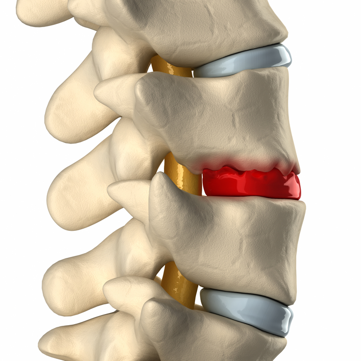 Image depicting a degenerative disc (bulging disc) in a spine